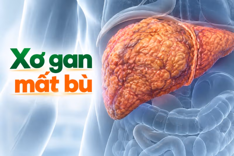 Xơ gan mất bù là tình trạng nặng, khi gan không còn khả năng duy trì các chức năng thiết yếu.