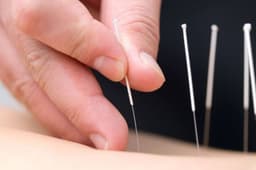 Châm cứu đau thần kinh tọa có hiệu quả không? Thông tin chi tiết và lưu ý cần biết 