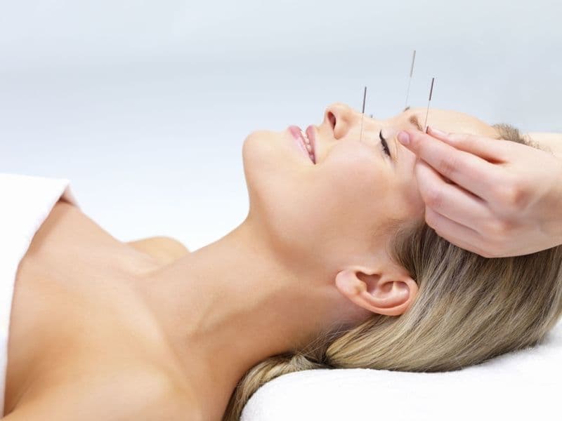 Châm cứu mất ngủ giúp giảm căng thẳng và hỗ trợ cải thiện chất lượng giấc ngủ 