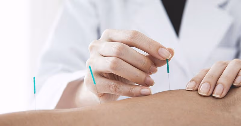 Châm cứu là phương pháp điều trị thuộc Y học cổ truyền đã có lịch sử lâu đời 