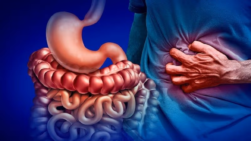 Bệnh Crohn là một bệnh viêm ruột mạn tính (IBD), xảy ra khi tình trạng viêm xuất hiện trong đường tiêu hóa