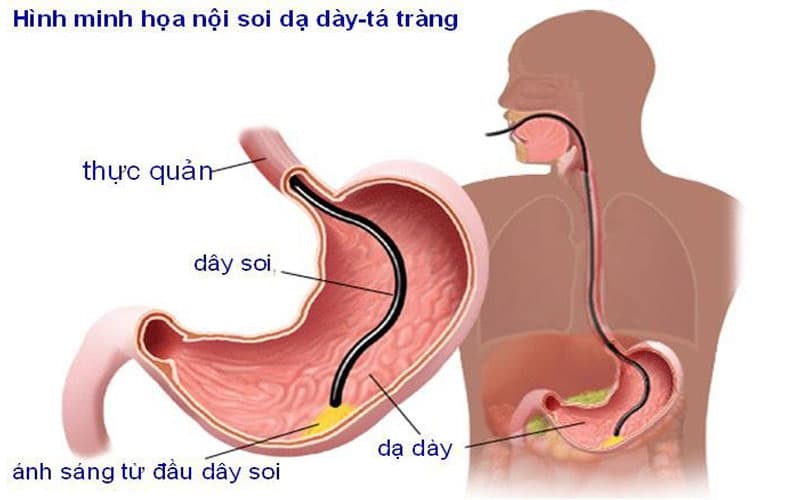Nội soi ống tiêu hóa trên có thể giúp chẩn đoán xác định hẹp môn vị