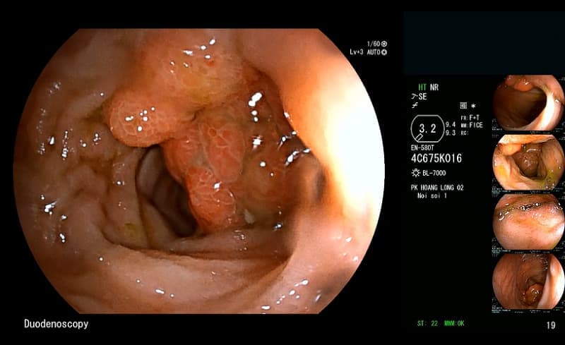 Chẩn đoán polyp ruột non bằng phương pháp nội soi