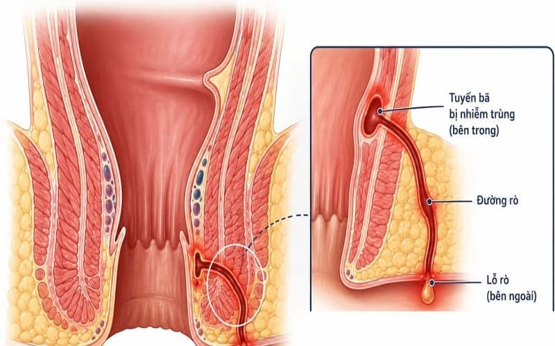 Rò quanh hậu môn là đường hầm bất thường nối ống hậu môn với vùng da xung quanh