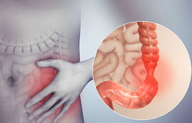 Khi xây dựng chế độ ăn túi thừa đại tràng, cần dựa vào tình trạng tiêu hóa và giai đoạn bệnh thay vì kiêng khem quá mức