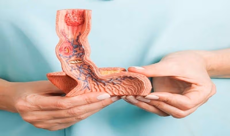 Ung thư thực quản là bệnh lý ác tính hình thành từ các tế bào của thực quản