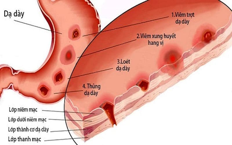 Có nhiều yếu tố làm suy yếu hàng rào bảo vệ niêm mạc, khiến axit và các chất tiêu hoá trong dạ dày dễ gây tổn thương
