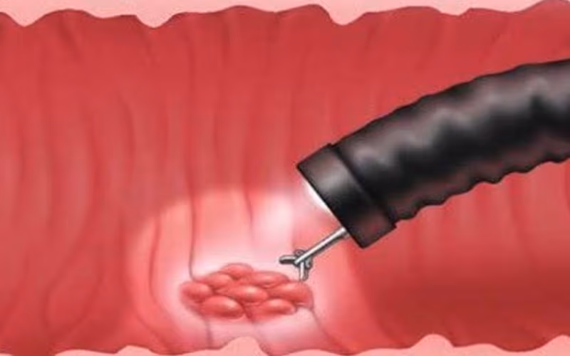 Nội soi kèm sinh thiết giúp chẩn đoán viêm đại tràng vi thể 