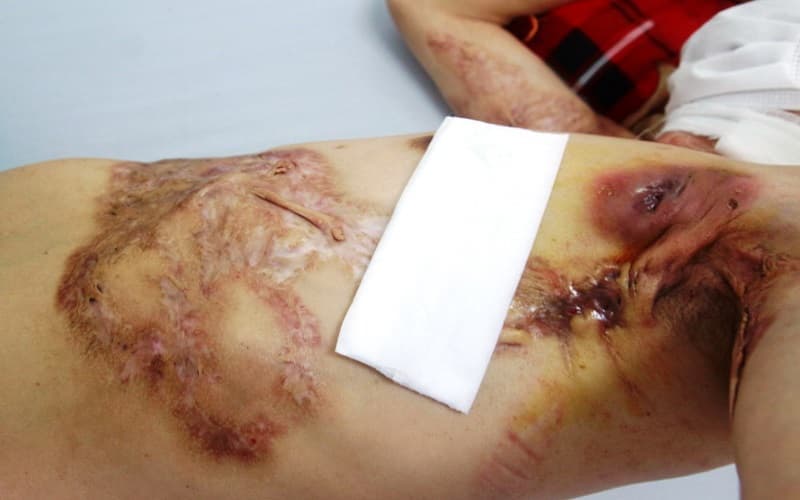 Chẩn đoán viêm tuyến mồ hôi mủ dựa trên tổn thương và diễn tiến tái phát