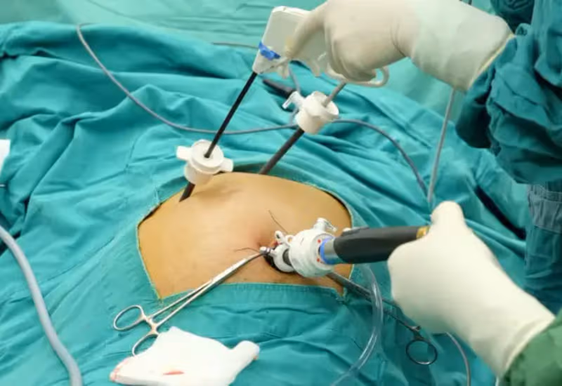 Phẫu thuật cắt túi mật thường được cân nhắc ở người bệnh viêm túi mật mạn có triệu chứng tái diễn