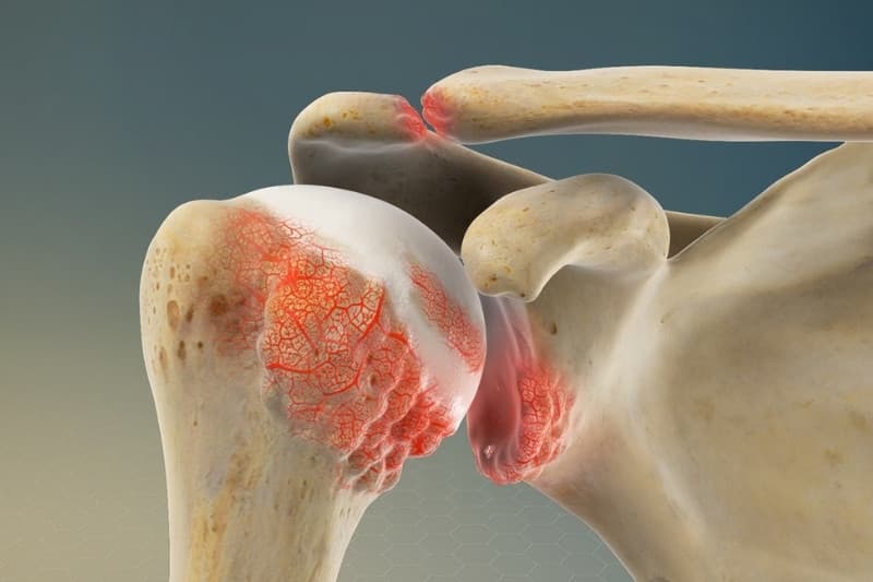 Tình trạng cọ xát gây ra sưng viêm và đau nhức dữ dội