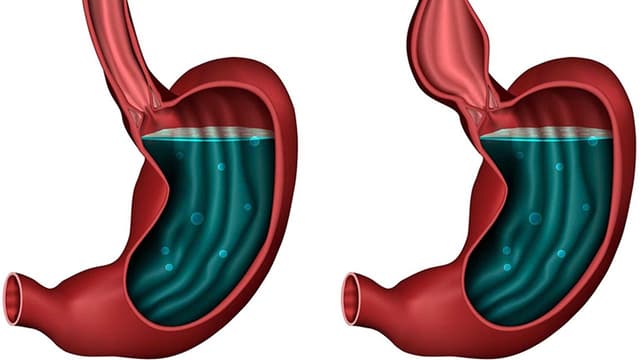 Co thắt tâm vị là gì? Các triệu chứng thường gặp