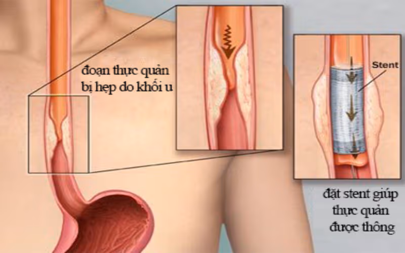 Đặt stent giúp điều trị hẹp thực quản