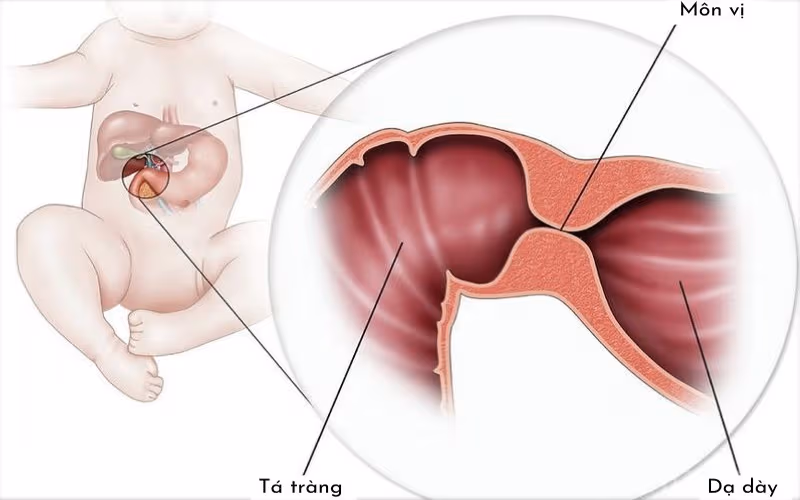 Hẹp môn vị có thể xuất hiện ở trẻ sơ sinh