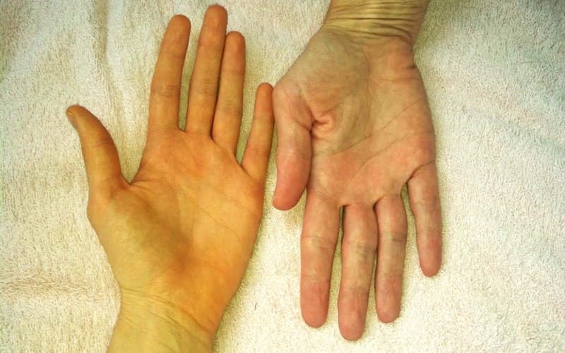 Những dấu hiệu điển hình của người bệnh mắc nang gan