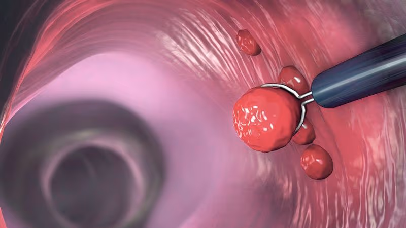 Polyp răng cưa đại tràng là một dạng tổn thương phát triển trên niêm mạc đại tràng