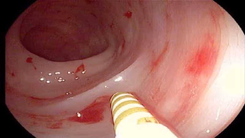 Chảy máu tiêu hóa là dấu hiệu có thể gặp khi polyp ruột non bị tổn thương