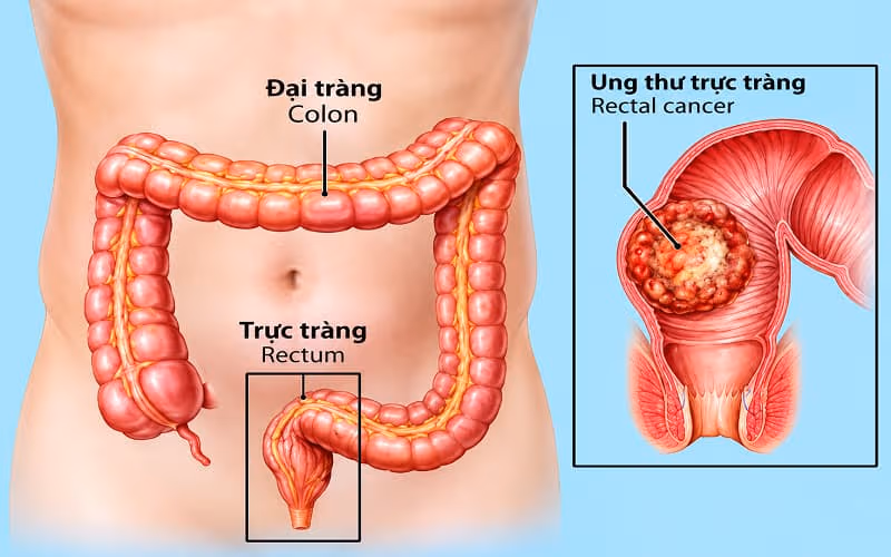 Polyp trực tràng có khả năng đột biến di truyền và hóa ung thư