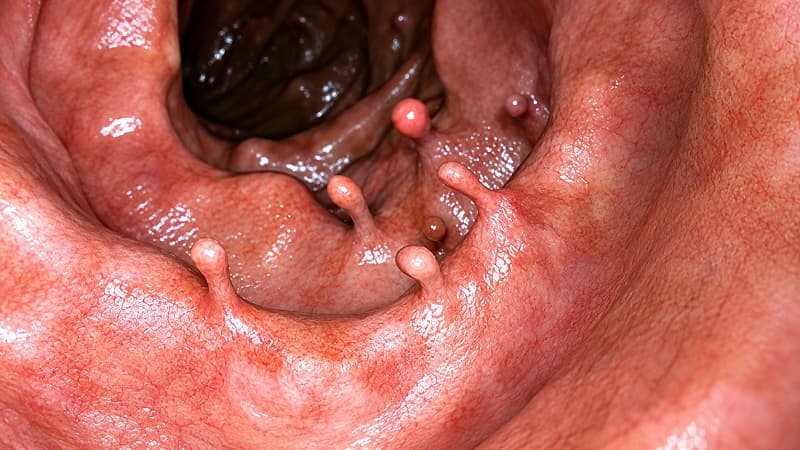 Polyp trực tràng có thể có cuống hoặc không cuống