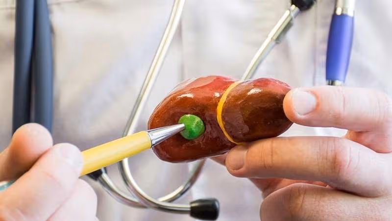 Polyp túi mật là những tổn thương dạng tăng sinh nhô vào trong lòng túi mật
