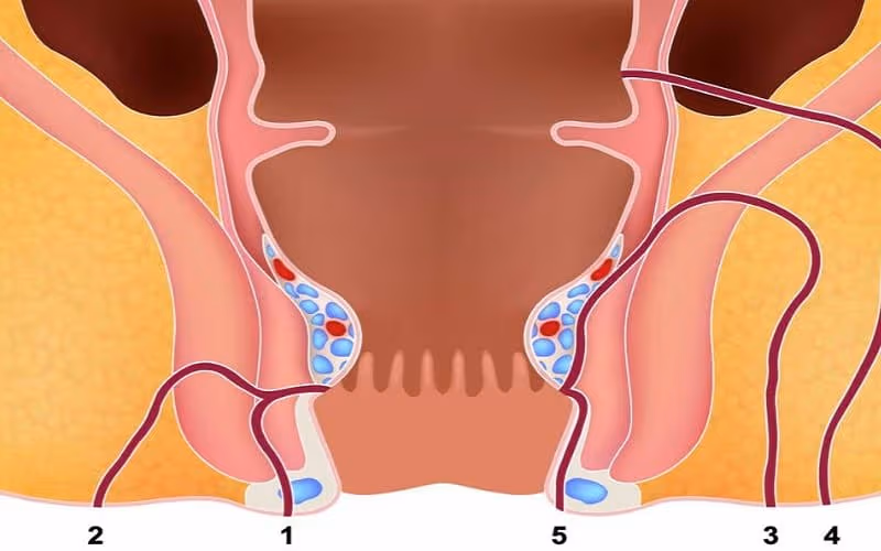 Đường rò nhiều nhánh khiến việc điều trị phức tạp, tăng nguy cơ tái phát