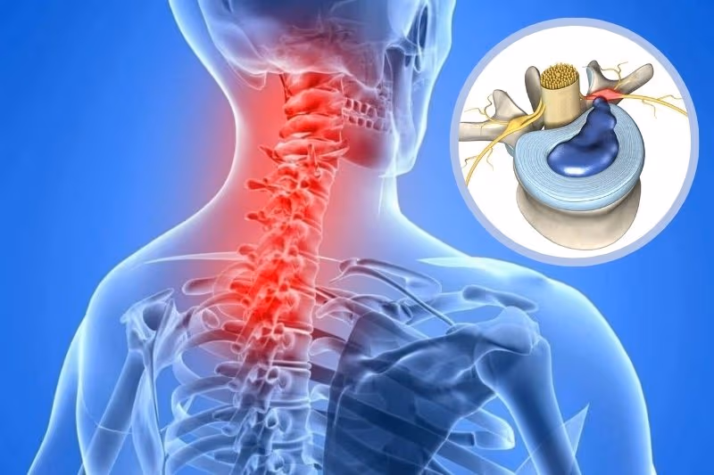 Khi vòng xơ bị rách, nhân nhầy tràn ra ngoài chứa chất gây viêm, kích thích rễ thần kinh