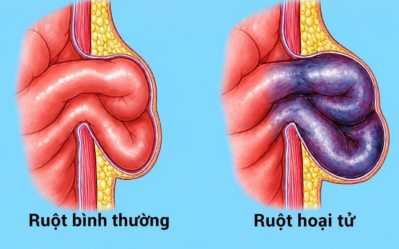 Thoát vị thượng vị có thể gây hoại tử ruột