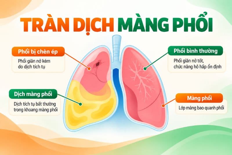 Tràn dịch màng phổi xảy ra khi lượng dịch tích tụ trong phổi vượt quá khả năng hấp thu.