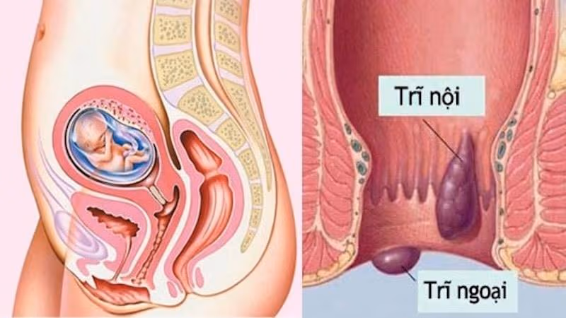Trĩ thai kỳ là tình trạng các mạch máu ở hậu môn và trực tràng dưới bị sưng giãn, hình thành búi trĩ
