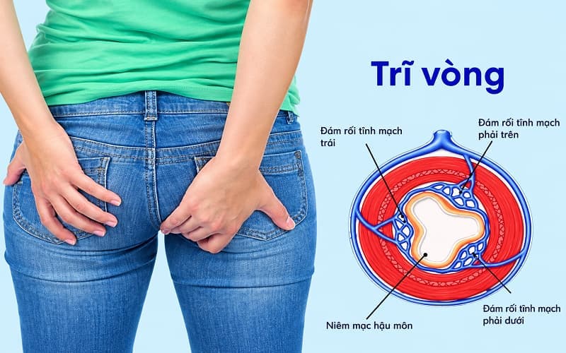 Trĩ vòng gồm nhiều búi trĩ liên kết tạo thành một vòng bao quanh hậu môn