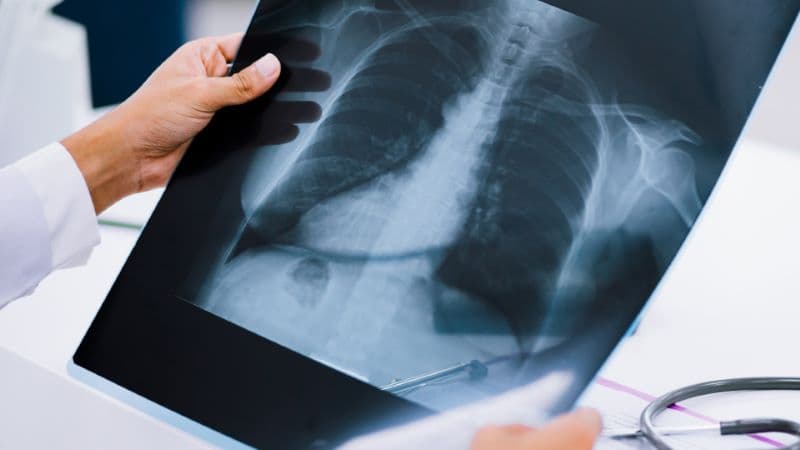 X-quang bụng có thể phát hiện vùng vôi hóa ở vị trí túi mật, nhưng không phải trường hợp nào cũng biểu hiện rõ