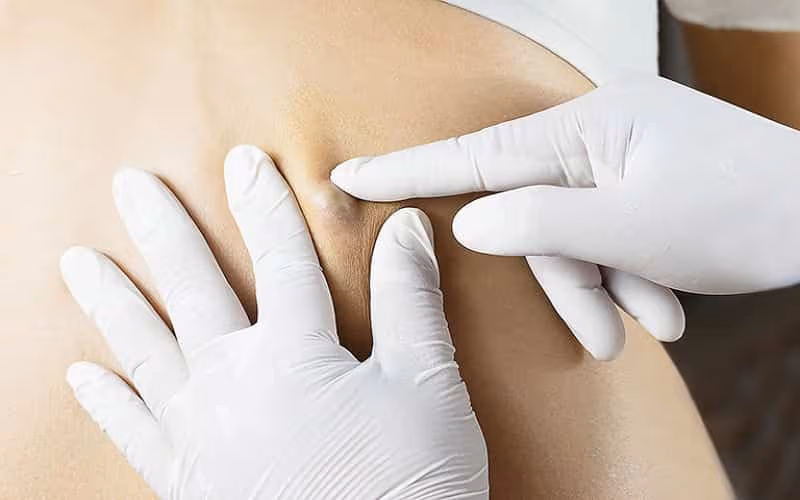 U nang bì dưới da có kích thước nhỏ, mọc bất kỳ vị trí nào trên cơ thể