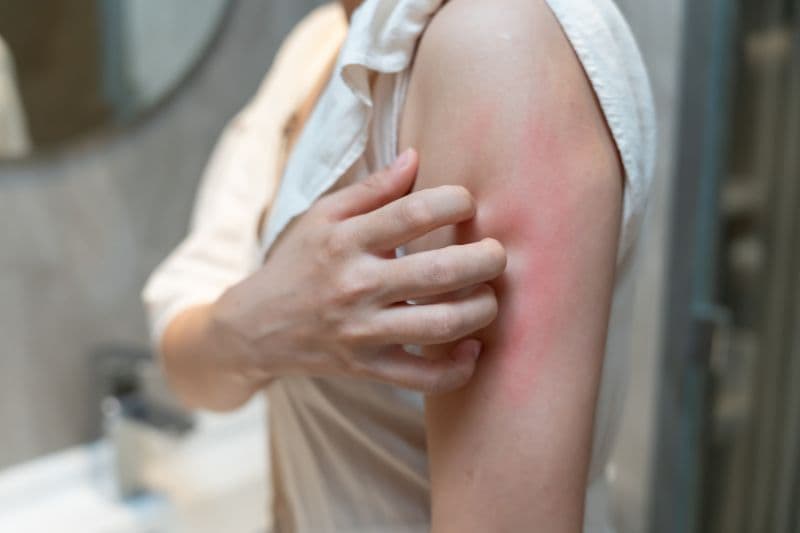 Mẩn ngứa có thể là một trong những dấu hiệu cho thấy gan đang tổn thương.