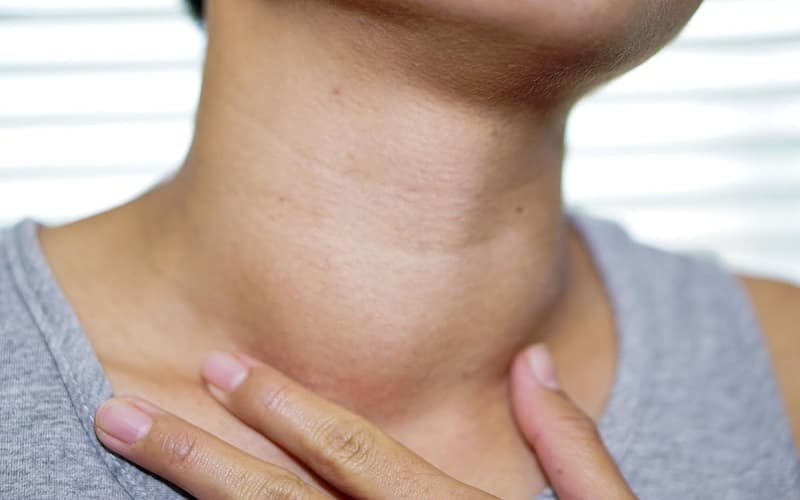 Viêm tuyến giáp là tình trạng tuyến giáp - cơ quan hình cánh bướm nằm ở phía trước cổ bị viêm và tổn thương