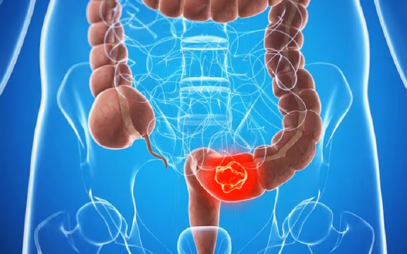 Phác đồ điều trị ung thư đại tràng dựa trên giai đoạn bệnh