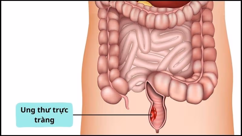 Ung thư trực tràng là bệnh lý ác tính hình thành ở đoạn cuối của ruột già