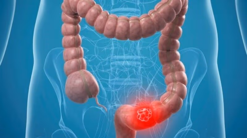 Mức độ nguy hiểm của bệnh Crohn không giống nhau ở mọi người