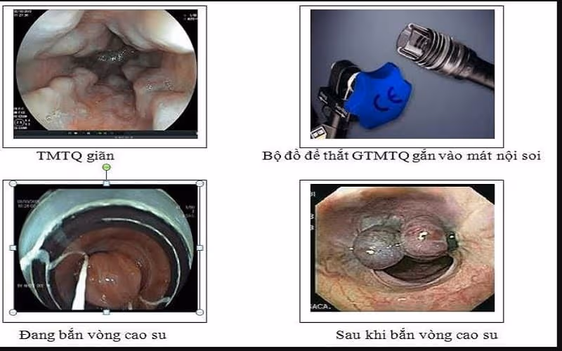 Điều trị giãn tĩnh mạch thực quản nhằm giảm áp lực và kiểm soát xuất huyết