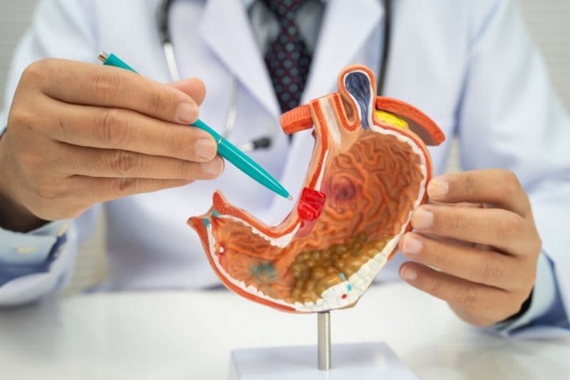 Phương pháp điều trị GIST dạ dày phụ thuộc vào kích thước, vị trí khối u và nguy cơ tái phát