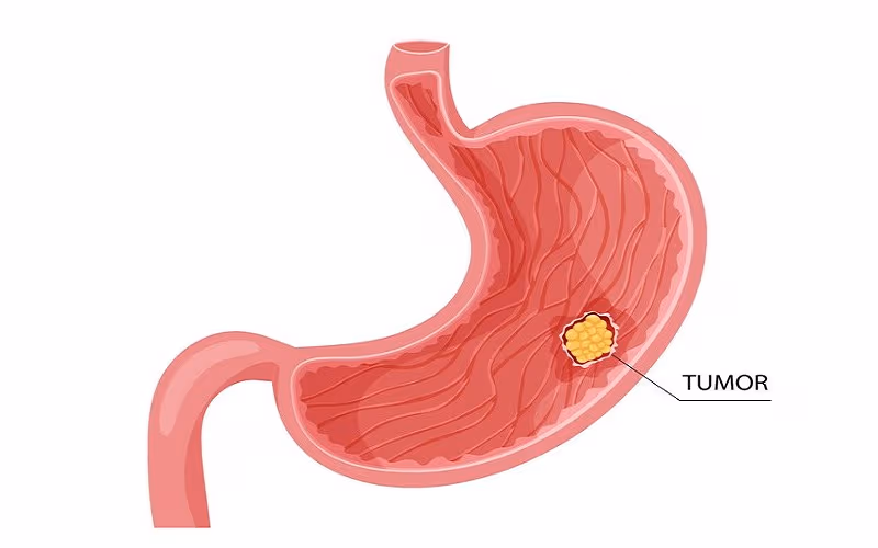 GIST dạ dày là một loại u thuộc nhóm khối u mô đệm đường tiêu hóa