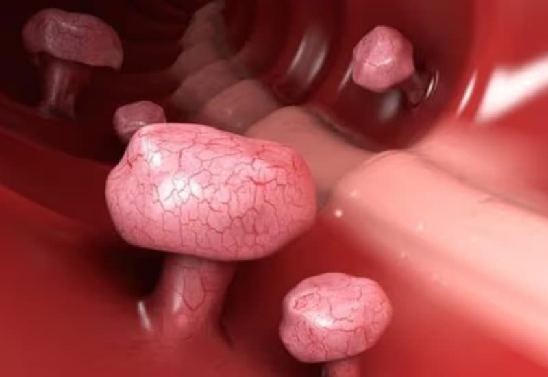 Các phương pháp điều trị polyp đại tràng lên