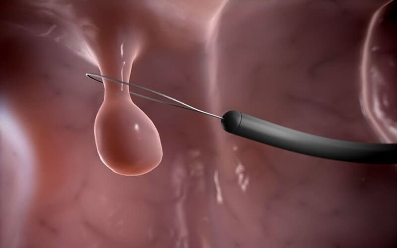 Điều trị Polyp hậu môn bằng nội soi ống mềm