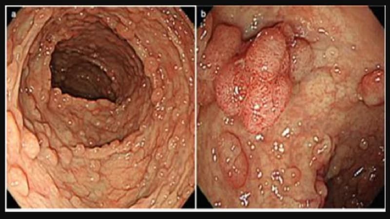 Người mắc đa polyp có nguy cơ xuất hiện polyp ở ruột non cao hơn