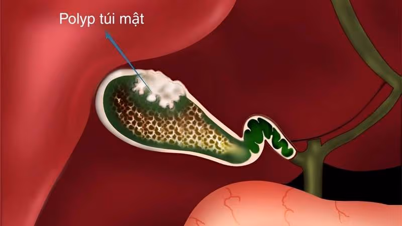 Với polyp túi mật nhỏ và chưa có yếu tố nguy cơ, bác sĩ có thể chỉ định siêu âm theo dõi định kỳ thay vì điều trị ngay