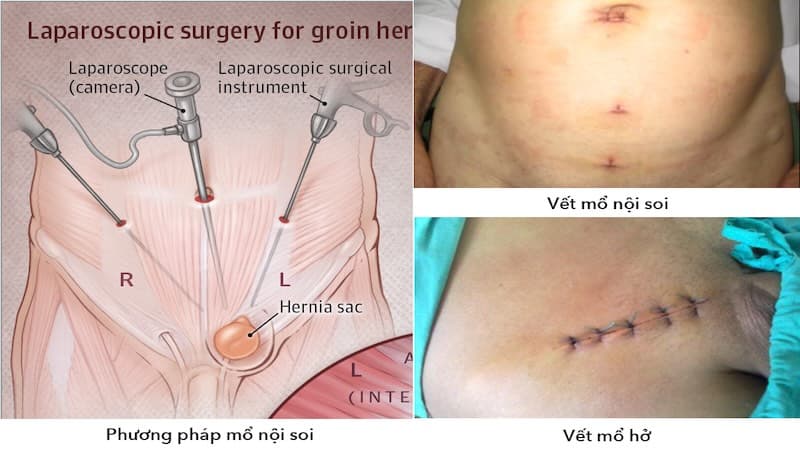 Phẫu thuật là phương pháp điều trị thoát vị bẹn phổ biến, giúp đưa phần mô hoặc ruột thoát vị về vị trí bình thường