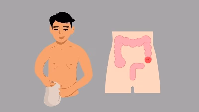 Thoát vị cạnh hậu môn nhân tạo là tình trạng một phần ruột hoặc mô trong ổ bụng đẩy qua vùng thành bụng bị suy yếu ngay bên cạnh hậu môn nhân tạo