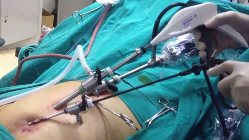 Điều trị thoát vị vết mổ cần nhanh chóng để phòng tránh biến chứng