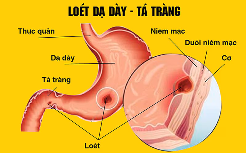 Viêm loét dạ dày là nguyên hàng đầu gây thủng tá tràng