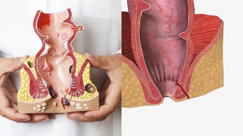 Điều trị trĩ kèm rò hậu môn cần dựa trên mức độ tổn thương