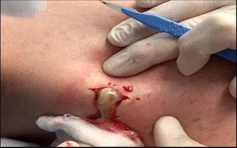 Rạch dẫn lưu mủ giảm tình trạng viêm